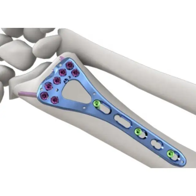 Hotsale 2024 Two Column Distal Radius Palmar Volar Plate Kinein