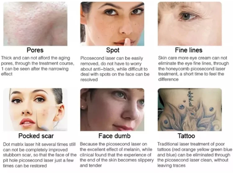 Professional Laser Tattoo Removal Machine For Sale 4 TECHNICAL SPECIFICATIONS <ul> <li>Power: 500W</li> <li>Voltage: 110V/220V; 50Hz/60Hz</li> <li>Screen size: 4.3in</li> <li>Laser wavelength: 532nm; 1064nm; 1320nm</li> <li>Pulse energy: 0-2000MJ</li> <li>Pulse frequency: 10Hz</li> <li>Spot diameter: 1-8mm adjustable</li> <li>Pulse width: 10ns</li> <li>Package size : 45*60*51cm</li> <li>Package weight: 25 kg</li> <li> <div>ReturnPolicy: <b class="magic-5"><span style="color: #2196ed;">30 Days Money back guarantee</span></b> <a href="http://skintechx.com/refund_returns" data-sm="true">Return Policy</a></div></li> <li> <div>ShippingDetails: <b class="magic-5"><span style="color: #2196ed;">FREE SHIPPING fast delivery</span></b> <a href="https://skintechx.com/shipping-policy" data-sm="true">Shipping policy</a></div></li> </ul> Professional Laser Tattoo Removal Machine For Sale