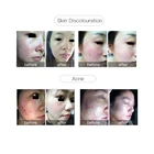 Acne Professional Ultrasonic Plasma Shower Wrinkle Removal Acne Treatment Beauty Machine