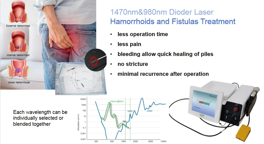 Hemorrhoid Fistula Diode Laser Surgery Plastic Machine For