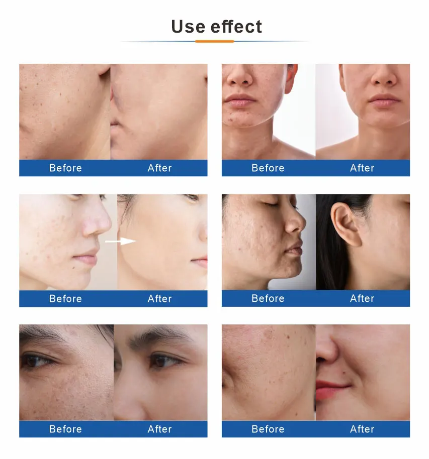 5-in-1 Professional Oxygen Hydro Dermabrasion Facial System for Clinics & Med Spas 13 Discover the 5-in-1 Oxygen Aqua Jet Peel Machine combining hydro dermabrasion, diamond peeling, oxygen jet infusion, and skin scrubber technology. Ideal for clinics and spas seeking advanced non-invasive facial solutions. 5-in-1 Professional Oxygen Hydro Dermabrasion Facial System for Clinics & Med Spas
