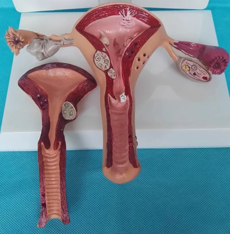 Female Pathological Uterine Anatomy Model Uterine Reproductive System