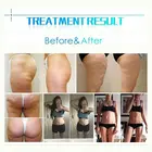 Weight Weight Loss Massage Roller Professional Vela Body Shape Slimming Machine Multifunction Vela 2 Shape