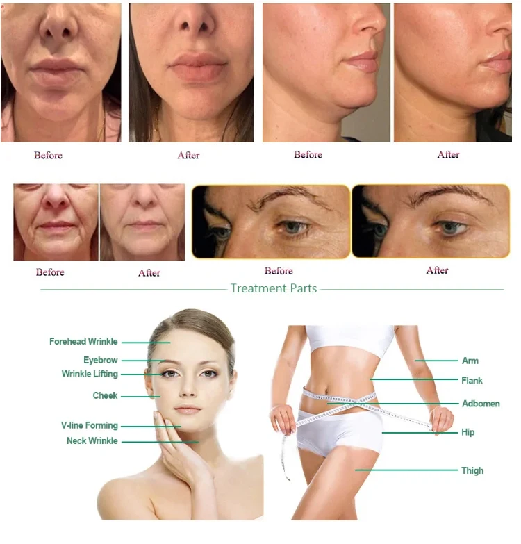 3rd Generation Ultra Lift HIFU Machine – Non-Surgical Face & Body Skin Tightening System 11 TECHNICAL SPECIFICATIONS <ul> <li>Power: 180W</li> <li>Voltage: 100V/110V/220V</li> <li>Screen Size: 18.5 inches touch screen</li> <li>HIfu Cartridges: ds10-1.5/ds10-1.5n/ds7-3.0n/ds7-3.0/ds4-4.5/ds7-4.5</li> <li>Cartridge Shots: 10,000 shots</li> <li>Dot distance: 1-2mm(Set unit 0.1mm)</li> <li>Frequency: 10MHz/7MHz/4MHZ</li> <li><span class="attr-name J-attr-name" title="HIFU Length" data-spm-anchor-id="a2700.wholesale.0.i34.67a066f4kJ6h3j">HIFU Length: </span>5.0~25mm 1mm/step</li> <li>Package Size: 55*54*37CM</li> <li>Package Weight: 21 kg</li> <li>ReturnPolicy: <b class="magic-5"><span style="color: #2196ed;">30 Days Money back guarantee</span></b> <a href="http://skintechx.com/refund_returns" data-sm="true">Return Policy</a></li> <li>ShippingDetails: <b class="magic-5"><span style="color: #2196ed;">FREE SHIPPING fast delivery</span></b> <a href="https://skintechx.com/shipping-policy" data-sm="true">Shipping policy</a></li> </ul> 3rd Generation Ultra Lift HIFU Machine – Non-Surgical Face & Body Skin Tightening System