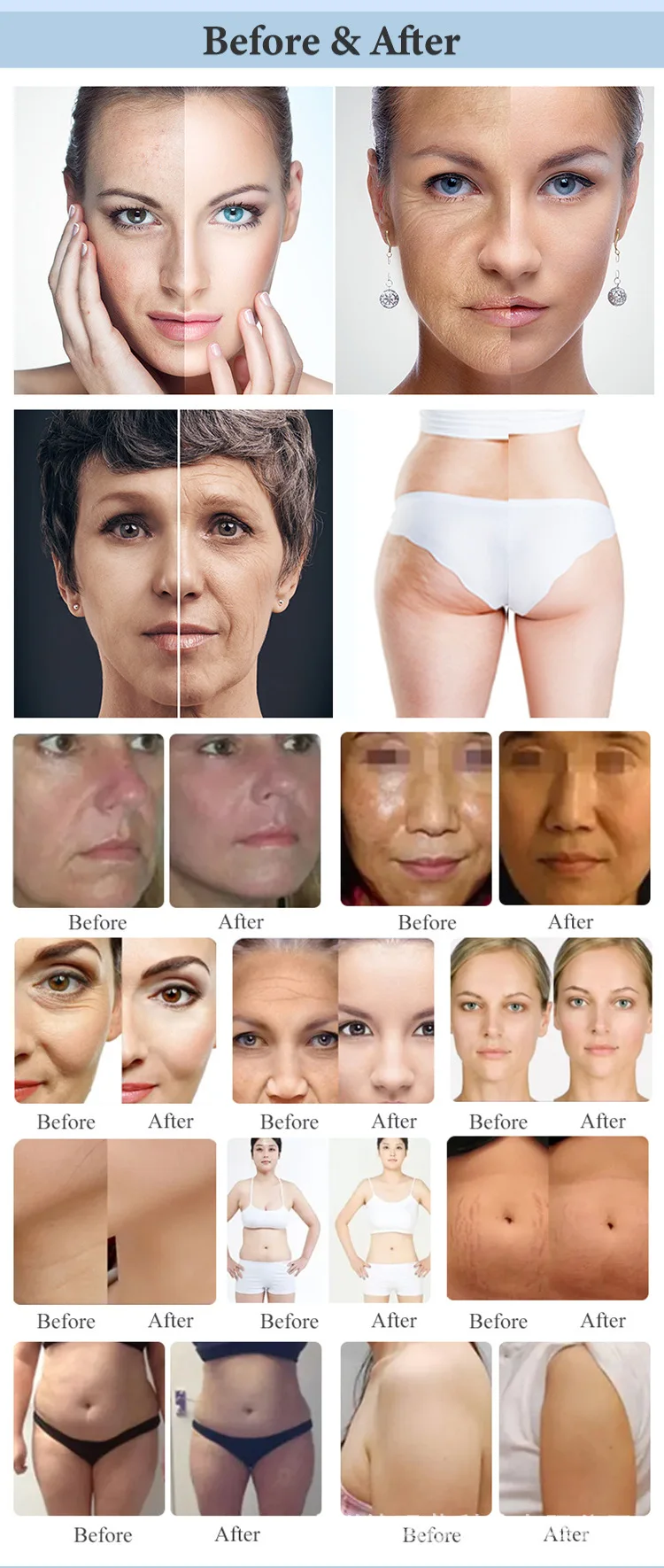 7D HIFU Machine – Face Lifting & Body Slimming Device for Salons 16 TECHNICAL SPECIFICATIONS <ul> <li>Power: 500W</li> <li>Voltage: 100V/110V/220V</li> <li>Energy output: 0.1J-3.0J</li> <li>Screen Size: 10.4 inches touch screen</li> <li>HIfu Cartridges: 1.5mm/2.0mm/3.0mm/4.5mm/6.0mm/9.0mm/13.0mm</li> <li>Cartridge Shots: 20,000 / 30,000 shots</li> <li>Dot distance: 1-2mm</li> <li>Frequency: 2MHz / 4MHz / 7MHz</li> <li><span class="attr-name J-attr-name" title="HIFU Length" data-spm-anchor-id="a2700.wholesale.0.i34.67a066f4kJ6h3j">HIFU Length: </span>5-25mm Adjustable</li> <li>Package Size: 57*51*131CM</li> <li>Package Weight: 36 kg</li> <li>ReturnPolicy: <b class="magic-5"><span style="color: #2196ed;">30 Days Money back guarantee</span></b> <a href="http://skintechx.com/refund_returns" data-sm="true">Return Policy</a></li> <li>ShippingDetails: <b class="magic-5"><span style="color: #2196ed;">FREE SHIPPING fast delivery</span></b> <a href="https://skintechx.com/shipping-policy" data-sm="true">Shipping policy</a></li> </ul> 7D HIFU Machine – Face Lifting & Body Slimming Device for Salons