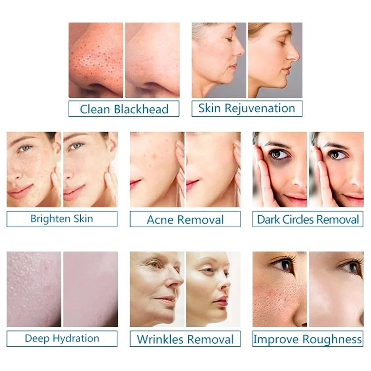 Hydro Facial Machine Professional Hydro Dermabrasion BIO Infusion Diamond Tip System 10 Aqua Hydrodermabrasion Facial Skin Care Deep Cleansing Peeling Pores Treatment Hydro Microdermabrasion Hydra Beauty Machine