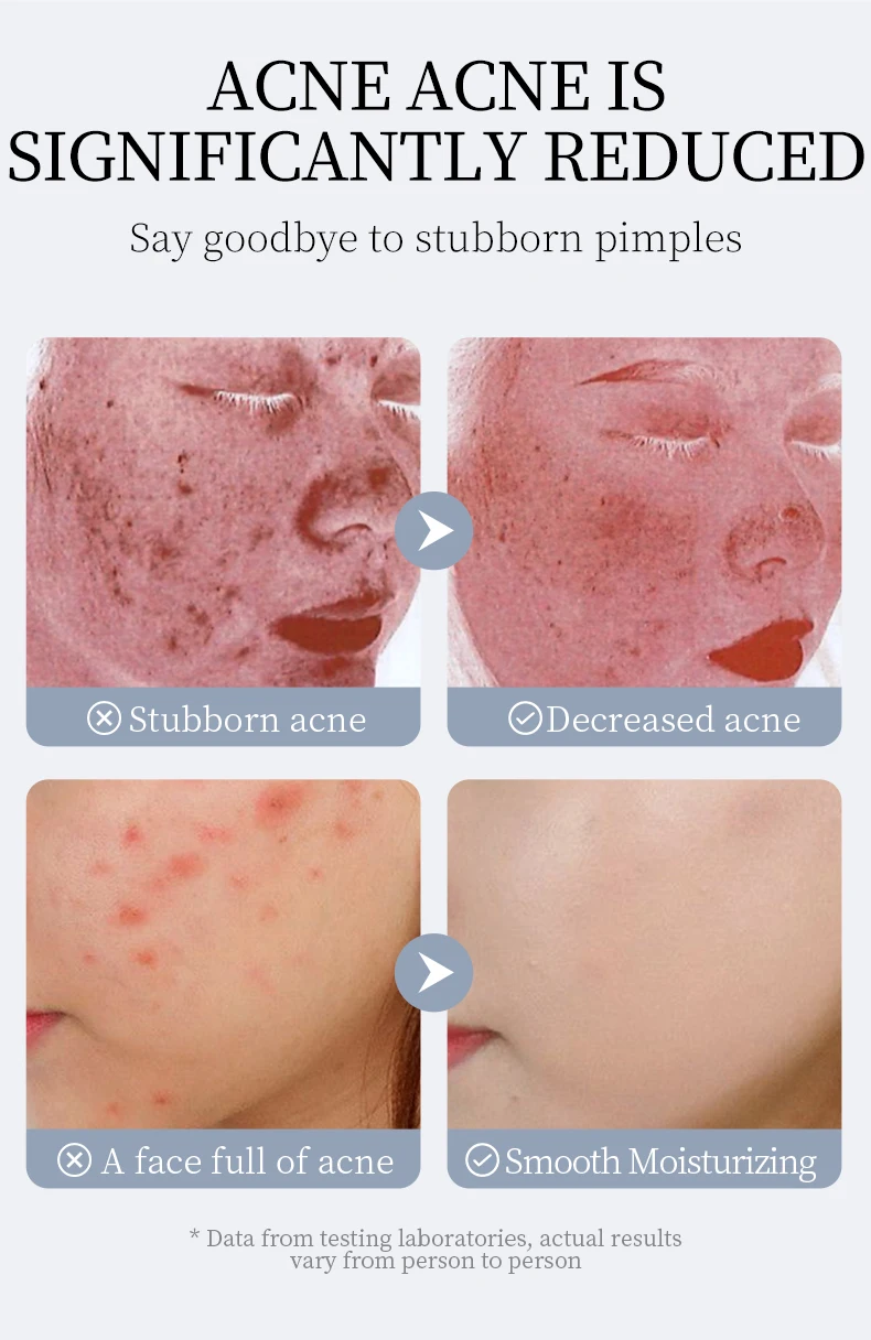 odm veze removing beverage cream pimple acne moisturizer face whitening cream-7