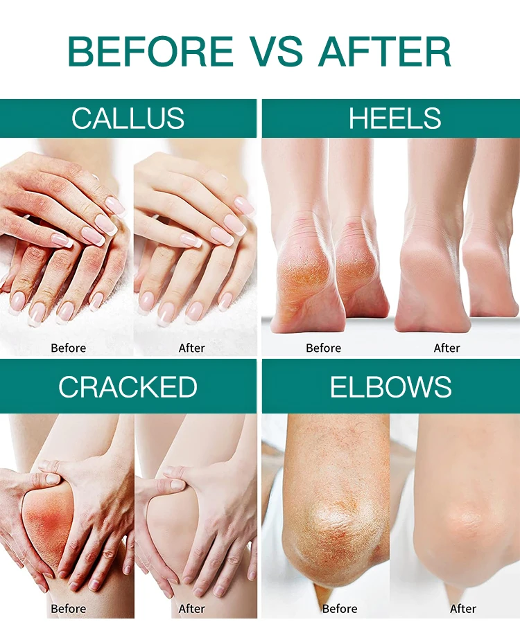 Foot care cream for cracked heels exfoliating anti crack peeling dead skin removal foot repair whitening urea foot cream