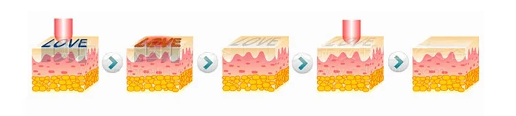 Best price professional q switch laser tattoo eyebrow tattoo removal carbon peeling birth mark removal