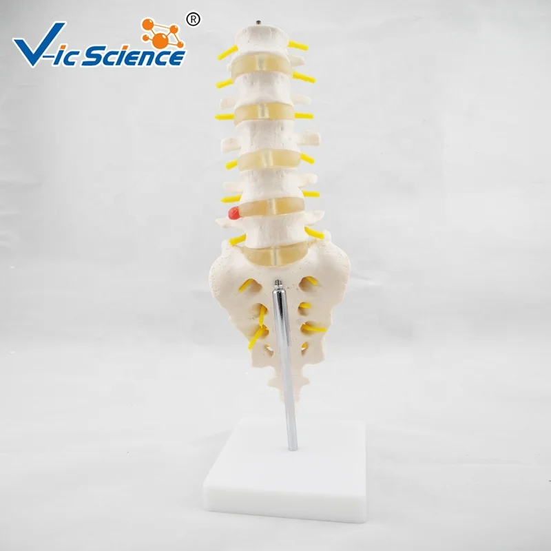 Life Size Lumbar Vertebrae With Sacrum Coccyx And Herniated Disc