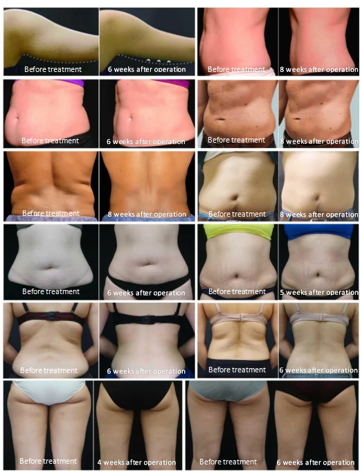 Ice sculpting body machine freezing ice sculpting machine