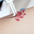 Hair Machine Best Quality Hair Picolaser Removal All Tattoo Treatment 2021 New Technology Picosecond Laser Machine