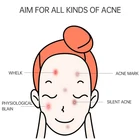 Care Quick Acne Pimples Care Scar Treatment Spot Removal Anti Acne Herbal Cream Acne Cream