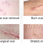 Essential Stretch Marks Remover Scar Removal Essential Massage Oil For Skin Care