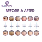 Laser Skin Ipl Yag Laser IPL YAG Laser Skin Rejuvenation Freckle Ipl Acne Treatment