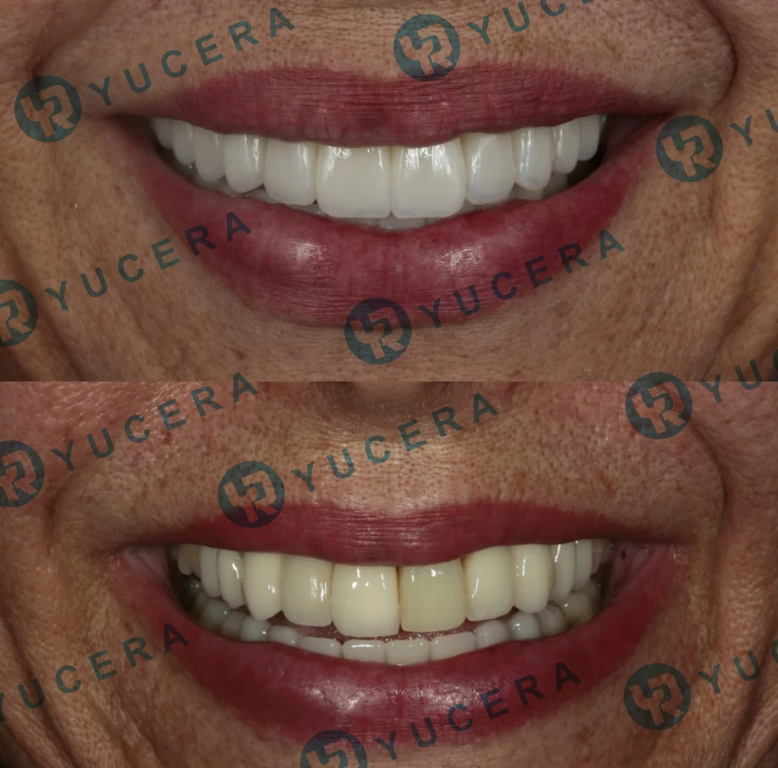 Highly Aesthetic Effect Dental Zirconium Blank SHT Multilayer 100 Powder in Dental Lab Use for Making Perfect Denture