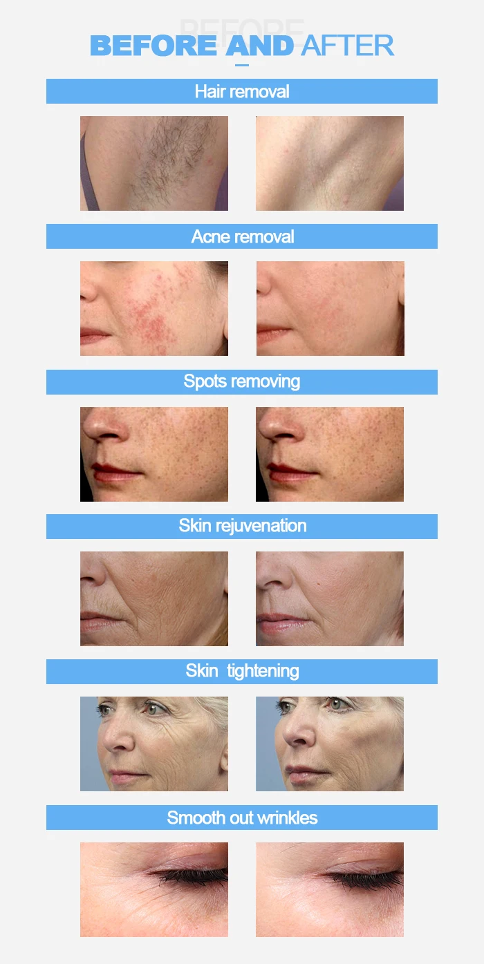 Multifunction IPL Skin Rejuvenation Machine Permanent Hair Remove Machine manufacture