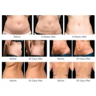Cellulite Reduction Slimming Cellulite Face Lifting Cellulite Reduction Rf Vela Shape Slimming Machine