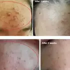 Care 3 In 1 Korean Technology Portable Skin Care Product Wrinkle Removal Spot Removal Plasma Machine