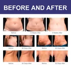 Cellulite Reduction Hot Sale Vacuum Cavitation RF Arm Body Cellulite Weight Reduction Lipo Slimming Machine
