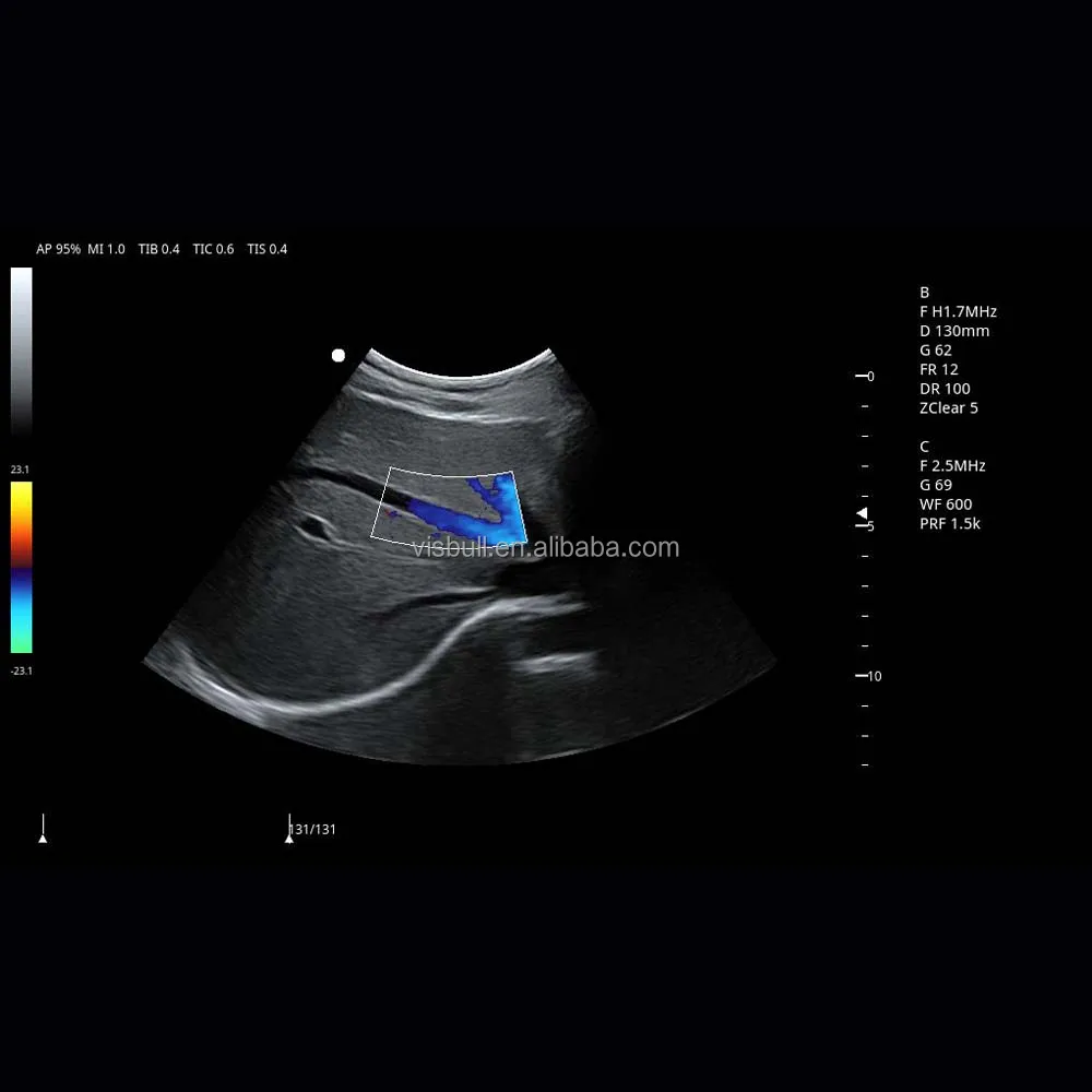 Hepatic vein C mode2.jpg