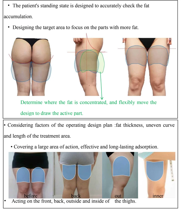 Cryolipolysis Fat Freezing + Ems Sculpting Machine 10 Fast Result Exercise Weight Loss Slimming Machine New Tech Rf Ems + Cryolipolysis Machine For Cellulite Removal Body Shape 2024