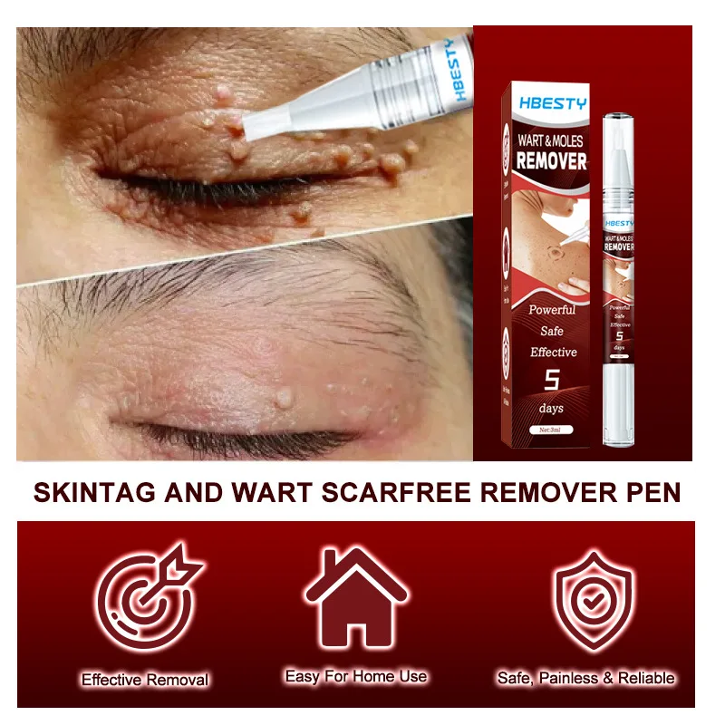 OEM Wart & Moles Cream for Improving Skin Problem