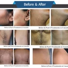 Beijing 2022 Beauty Equipment Manufacturers Direct Supply Permanent IPL Hair Removal Machine