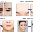 50iu 100iu 150iu Exposed Gums Shaping Facial Contours Botulax Korea Btx Injection