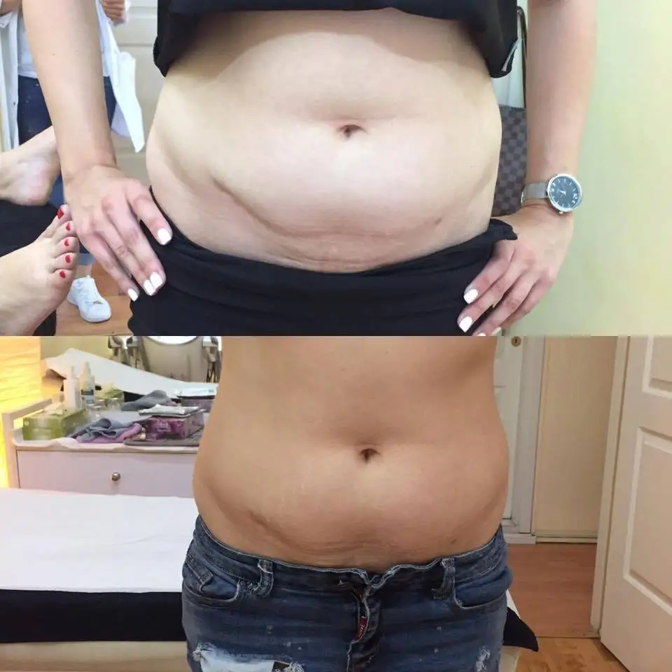 Sincoheren cooplas high quality performance cold sculpting beauty salon machine with CE