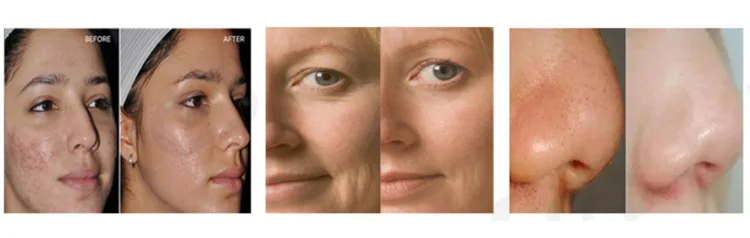 Hydra Diamond Microdermabrasion water jet Peel facial Machine