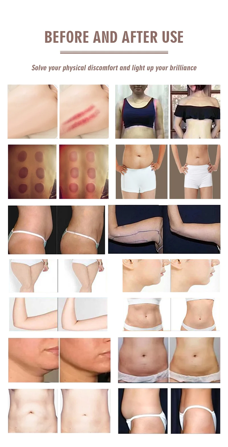 Professional 80K Cavitation Liposuction Machine 10-in-1 7 Discover the professional 10-in-1 80K cavitation liposuction machine with vacuum RF, lipolaser, BIO microcurrent, and multipolar RF technology for non-invasive body contouring and skin tightening treatments. Professional 80K Cavitation Liposuction Machine 10-in-1