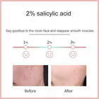 Cream Acne Mask Acne CASNER Salicylic Acid Anti-Acne Cream Acne Scar Remove Treatment Cleansing Facial Mask For All Skin