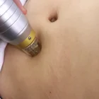 Removal Yting Skin Lifting Stretch Marks Removal Permanent Micro Needle RF Machine With Cold Hammer