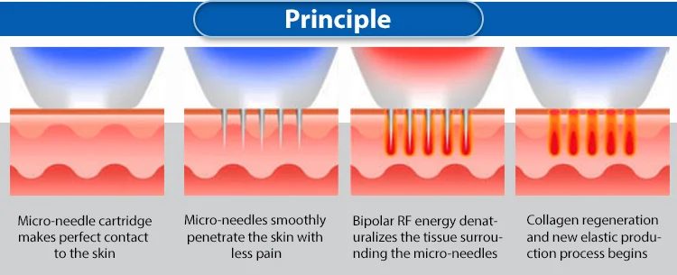 Vertical Microneedling RF