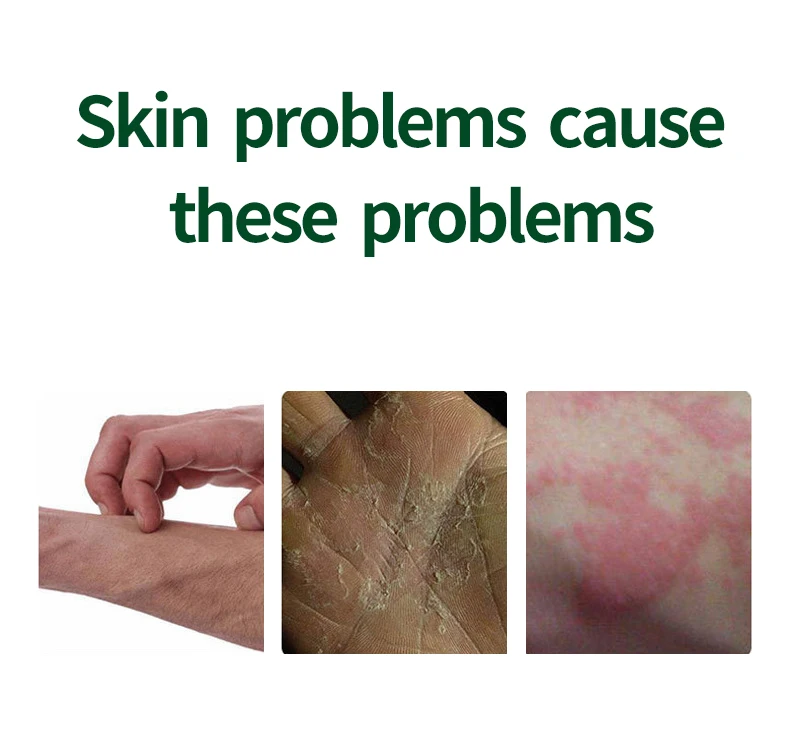 Free Sample Fungal Infection Dermatitis Eczema Ointment Treatment