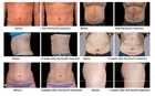 Stimulation Body Sculpting Contouring Electro Stimulation Muscle Teslasculpt Body Sculpt Machine
