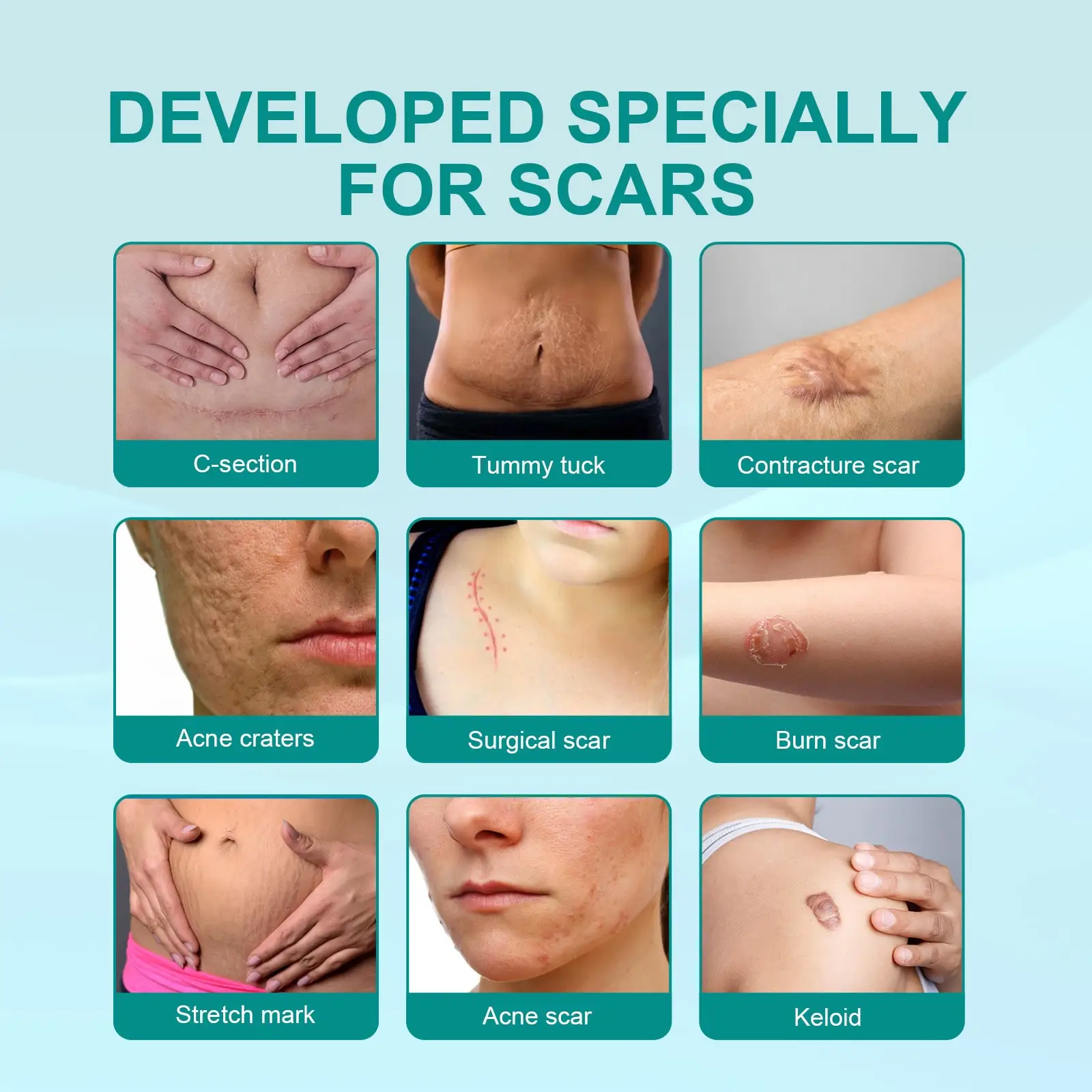 South Moon Scar Spray Cesarean Hyperplastic Contracture Burn Acne Surgical Scars Stretch Mark Keloid Treatment Liquid