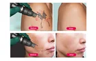Nd Removal Korea Hot Sales Nd Yag Picosecond Laser Pigmentation Removal Machine Beauty Salon Tattoo Removal