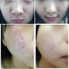Acne Removal Pen OEM Blue Led Acne Skin Care For Acne Solution Light Device Acne Scar Removal Pen