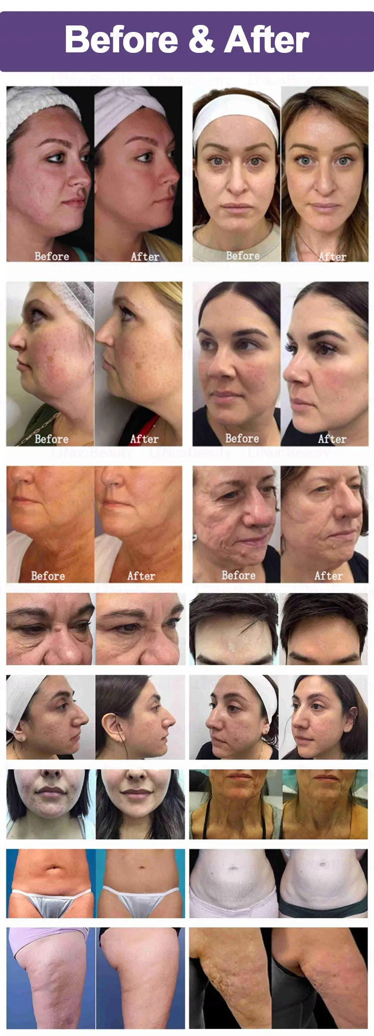 Professional 3-in-1 RF Microneedling Machine MFR + SFR + Ice Hammer System 10 Discover a professional 3-in-1 RF Microneedling Machine combining MFR, SFR, and Ice Hammer cooling for advanced skin tightening, acne scar removal, and collagen regeneration. Designed for clinics and med spas. Professional 3-in-1 RF Microneedling Machine MFR + SFR + Ice Hammer System