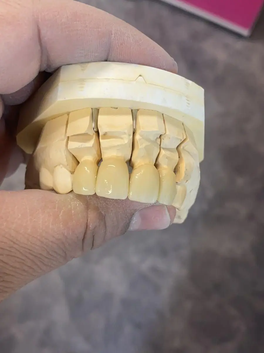 Laboratorio Dental Zirconia Ceramic Blocks for Cad Cam AG System 89mm