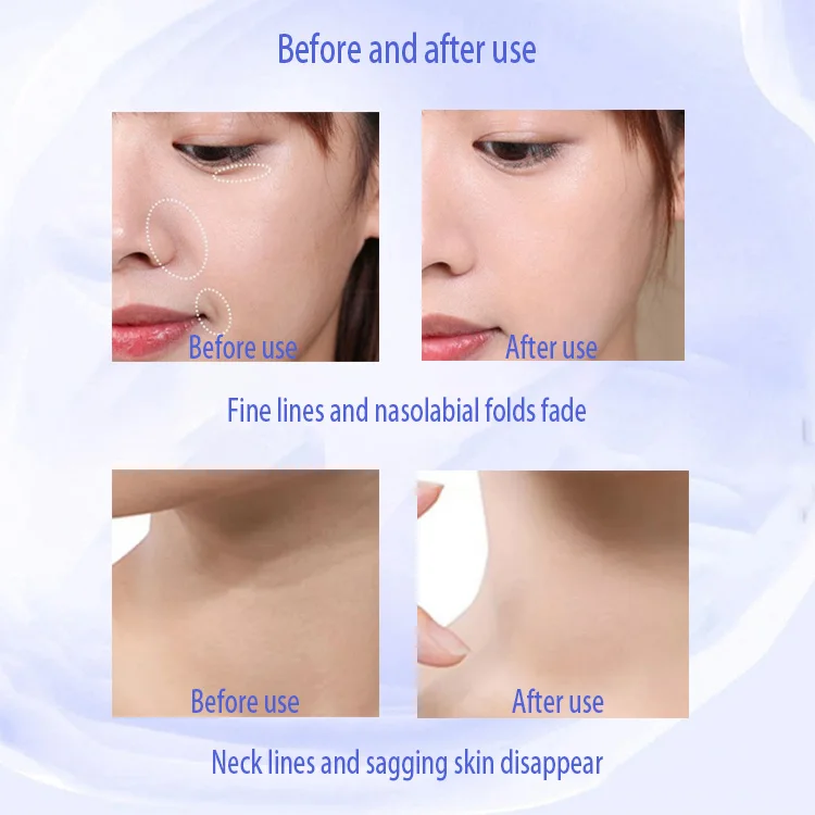 Aqua Facial Skin Analyzer Micro Hydro Dermabrasion Machine N7 Hydrogen-Oxygen Hydra Aqua Facial Cleansing Dermabrasion Machine