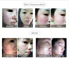 Skin 250w Dimei CE Approved Skin Care Plasma Face Lift Device Anti-aging Machine