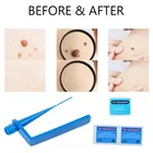 Face Lescolton Original Factory Pimple Wart Remover Kit Face Skin Mole Skin Tag Removal Solution