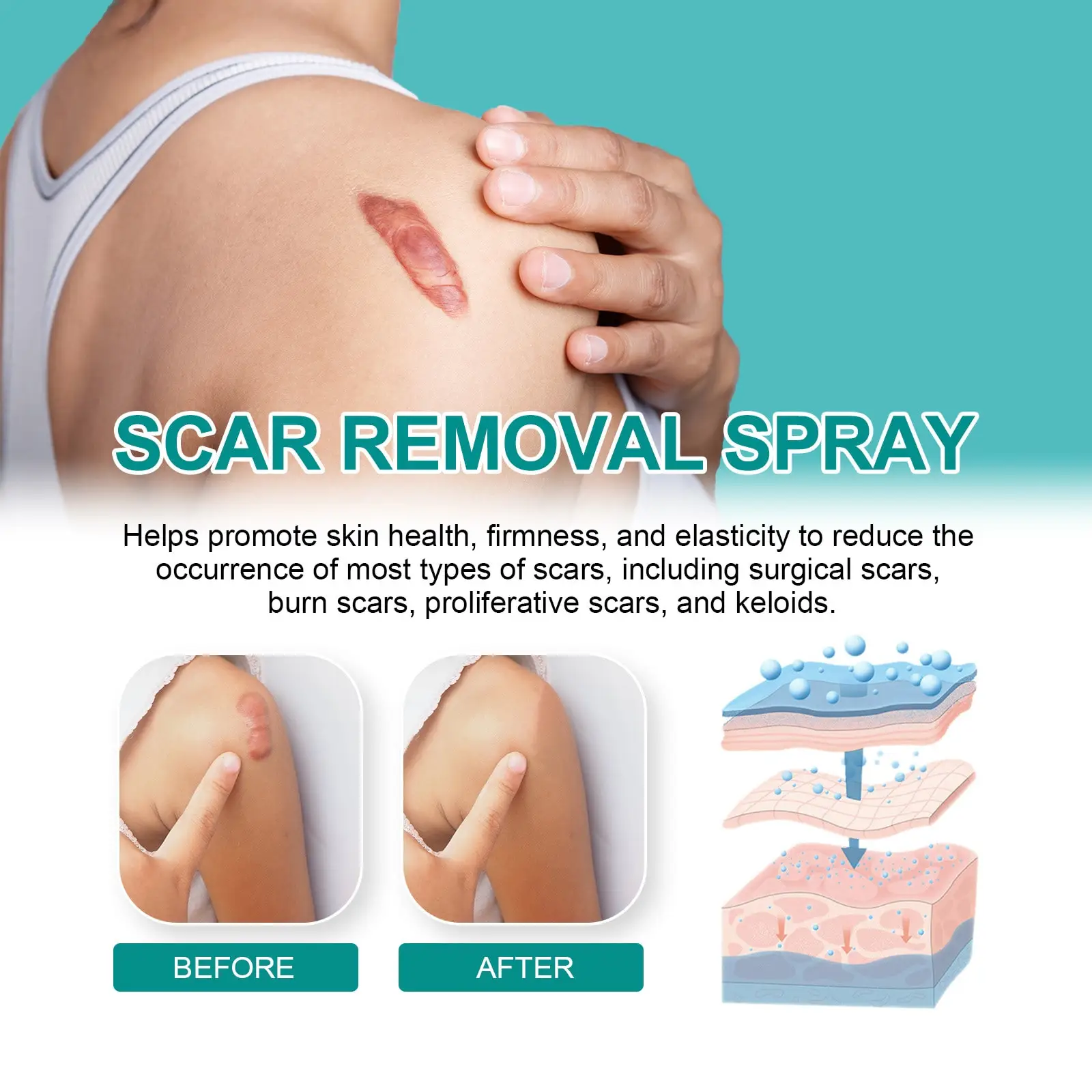 South Moon Scar Spray Cesarean Hyperplastic Contracture Burn Acne Surgical Scars Stretch Mark Keloid Treatment Liquid