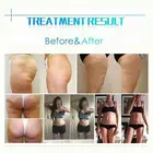 Breast Breast Lifting Equipment Cavitation Vaser Shape System Vela Iii Syneron Shape