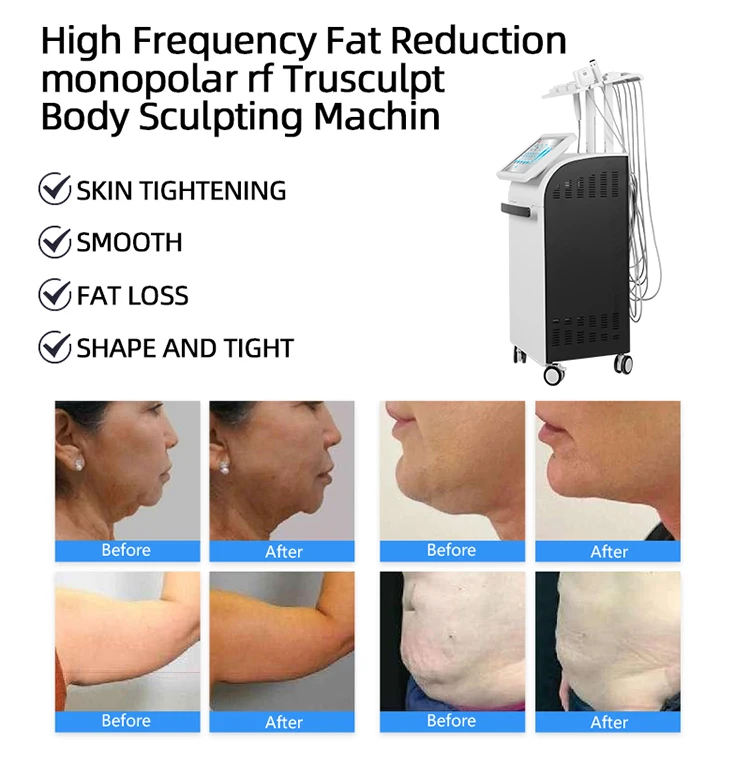 New Trusculpt Machine Monopolar Rf Skin Tightening Body Slimming