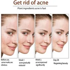 Cream Herbal Wholesale Price Mild Repair Acne Scar Essence Cream Herbal Multi Effect Anti-acne Cream