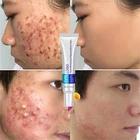 Cream Face Cream Ready To Ship Acne Removal Cream Private Label Day And Night Face Cream For Acne